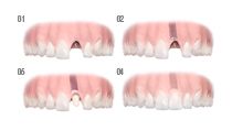 Zahnimplantate - Die Schritte